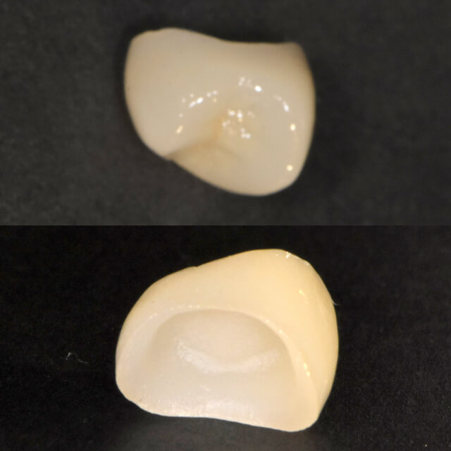 オールセラミッククラウン