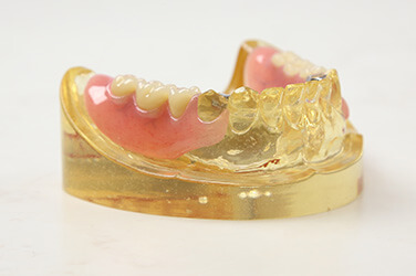 ノンクラスプデンチャー