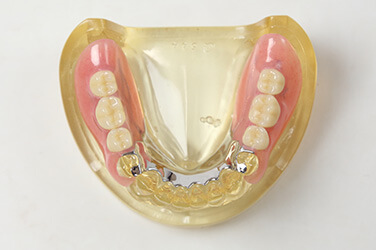 ノンクラスプデンチャー  メタルバック