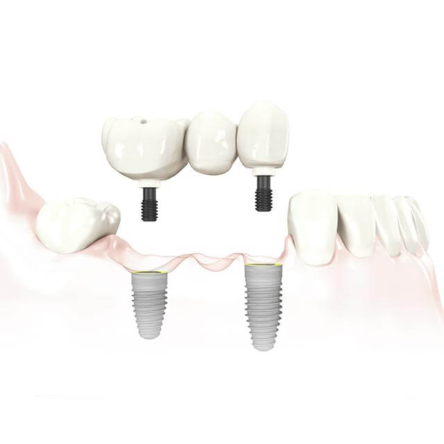 インプラントのイメージ