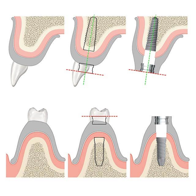 インプラント装着のイメージ