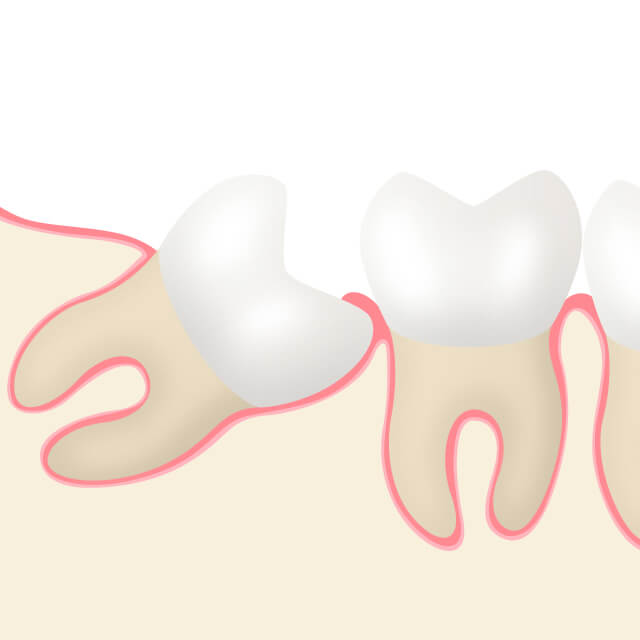 親知らず（智歯：ちし）