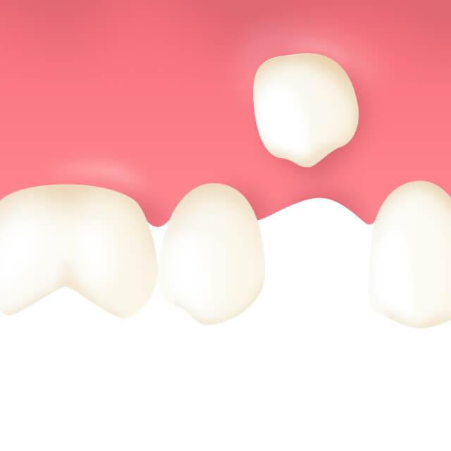 埋伏歯（まいふくし）